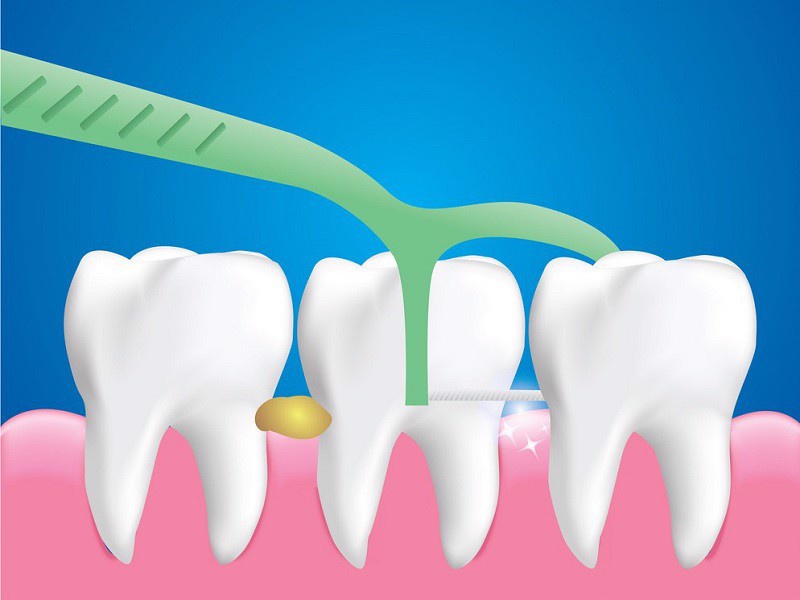 Chỉ nha khoa dùng được mấy lần