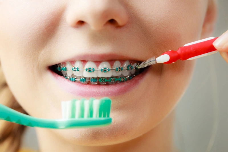 Khi nào cần dùng lò xo niềng răng? Thời gian sử dụng bao lâu?  3