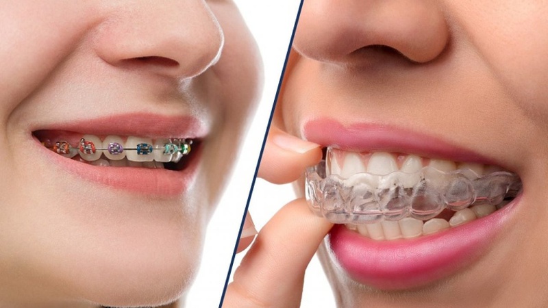 Cách vệ sinh răng miệng sau khi niềng răng