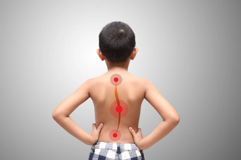 Vẹo cột sống ở trẻ cần điều trị như thế nào để không ảnh hưởng sức khoẻ 2