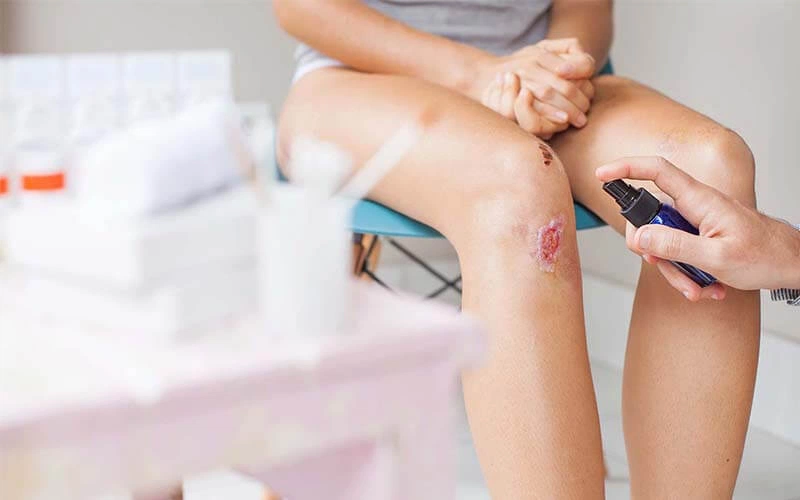 Vết thương hở ở đầu gối và những điều cần biết 3