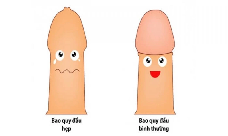 Vì sao có hiện tượng nghẹt bao quy đầu? 1