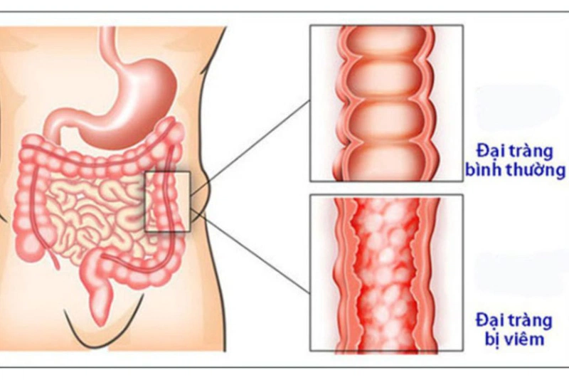 Vì sao người viêm đại tràng nên sử dụng bào tử lợi khuẩn LiveSpo Colon? 1