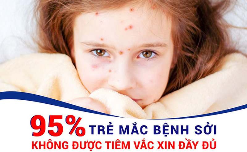 Vì sao trẻ dễ bị mắc bệnh sởi khi thời tiết giao mùa