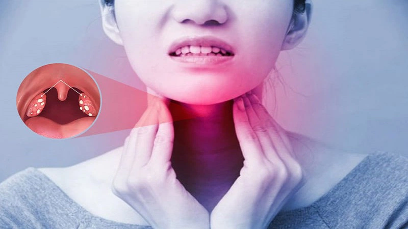 Tình trạng nhiễm amidan tái phát nhiều lần là do sự kết hợp các tác nhân từ đời sống và yếu tố sức khỏe