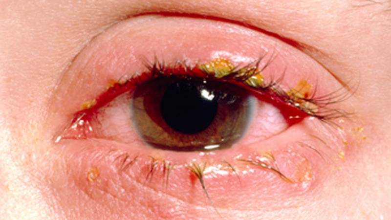 Viêm bờ mi mắt​ có nguy hiểm không? Cách nhận biết và điều trị hiệu quả 2