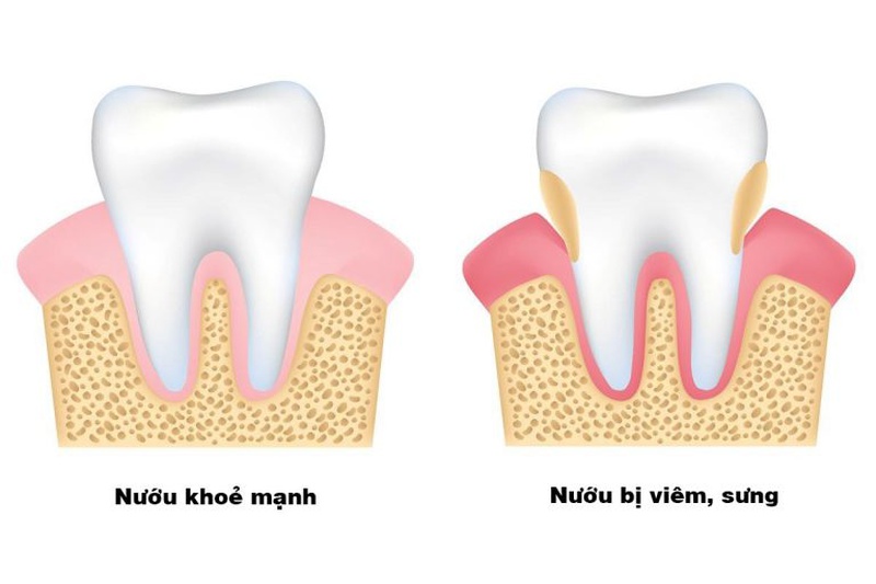 Viêm chân răng khôn và những điều cần biết