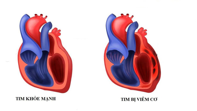 Viêm cơ tim là tình trạng lớp cơ dày của thành tim viêm, khiến cơ tim bị tổn thương viêm và hoại tử