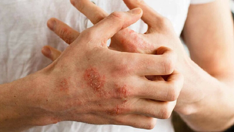 Viêm da cơ địa kiêng gì?