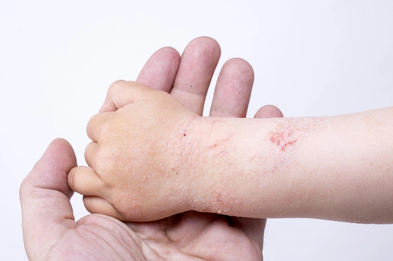 Triệu chứng phát hiện viêm da cơ địa ở trẻ em