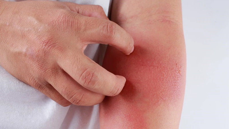 Viêm da dị ứng có để lại sẹo không? Làm cách nào điều trị? 1