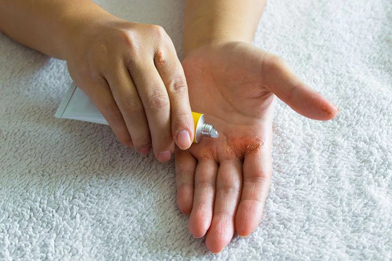 Viêm da dị ứng uống thuốc gì nhanh khỏi? 2