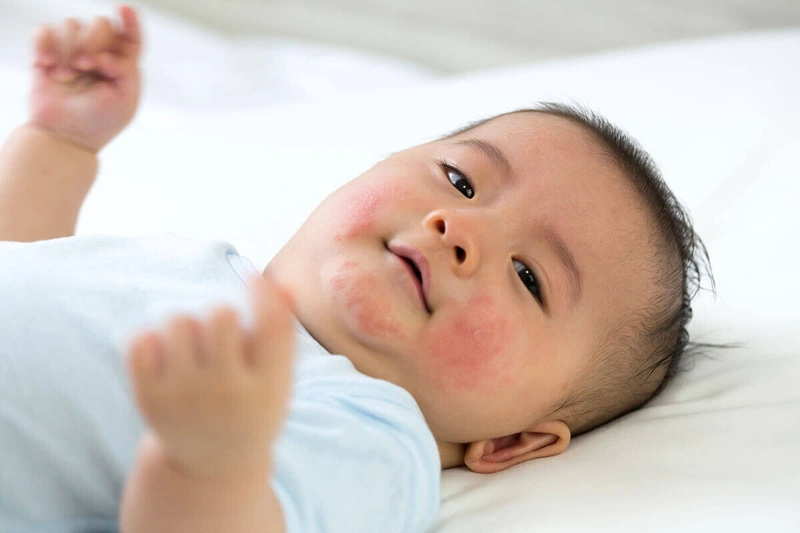 Tình trạng da bước vào giai đoạn mãn tính