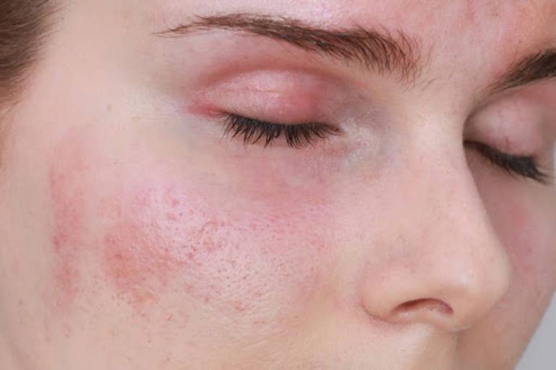 Giải đáp thắc mắc: Dị ứng da bôi thuốc gì cho nhanh khỏi? 1