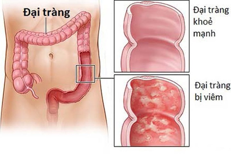 Viêm đại tràng và cách chữa trị bệnh hiệu quả 2