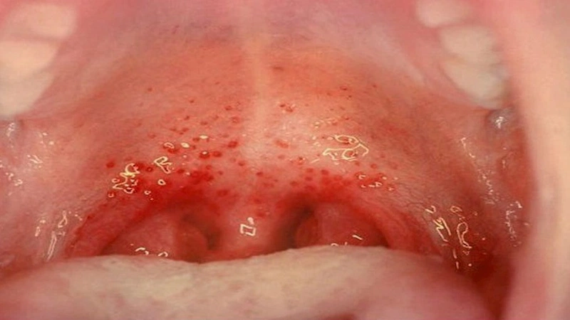 Nguyên nhân và cách điều trị viêm hầu họng hiệu quả 1