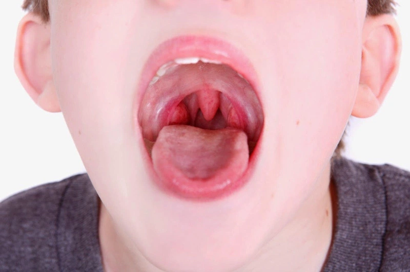 Viêm họng hạt ở lưỡi: Nguyên nhân và cách chữa bệnh