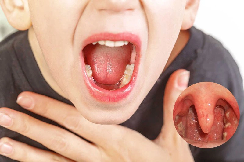 Viêm họng hạt ở lưỡi là một dạng của viêm họng mãn tính-3