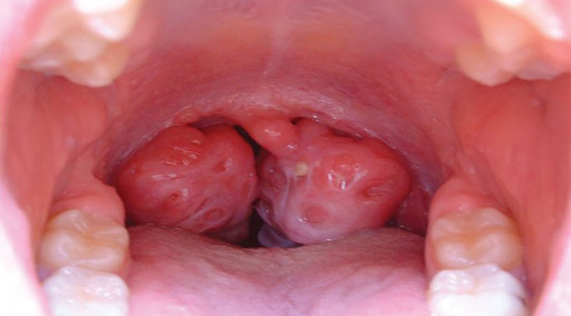 Viêm họng mưng mủ: Nguyên nhân và cách điều trị