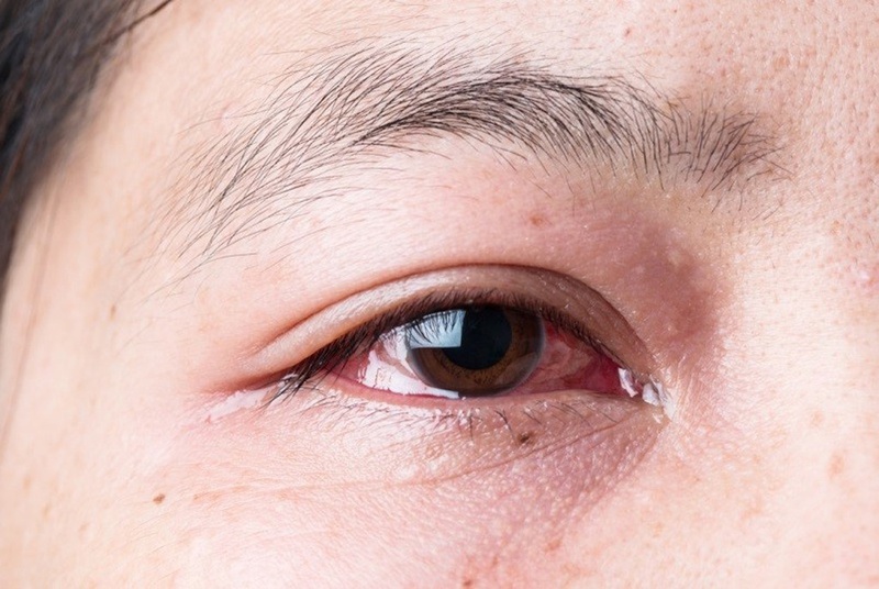 Quy trình chữa trị bệnh viêm kết mạc đau mắt đỏ 2