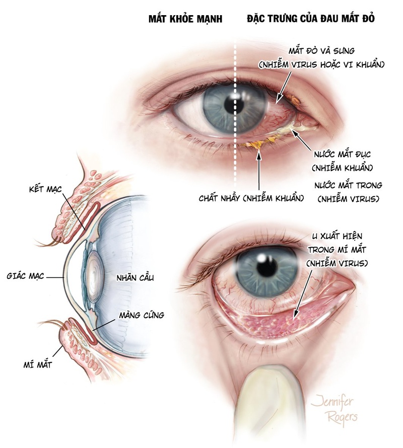 Viêm kết mạc mãn tính có lây truyền? Cách phòng ngừa và điều trị  1
