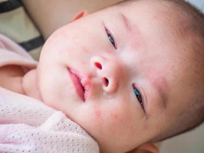Viêm lỗ chân lông trẻ em có nguy hiểm không? Chữa trị như thế nào? 1