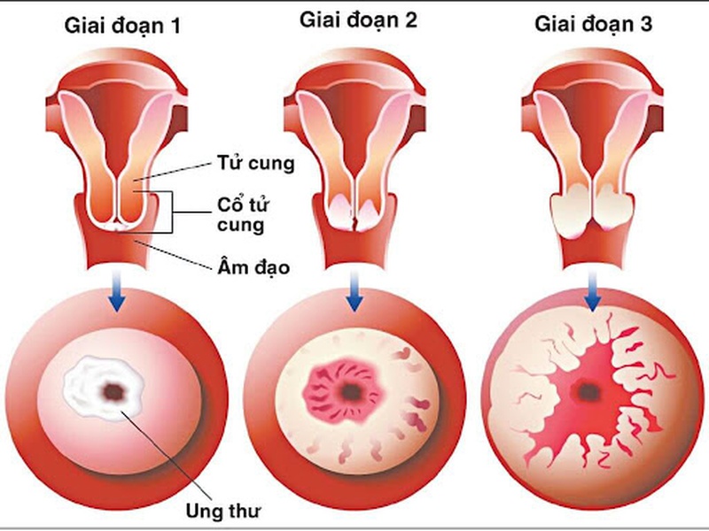 Viêm lộ tuyến tử cung có nguy hiểm không? Các phương pháp phòng chống bệnh như thế nào? 2