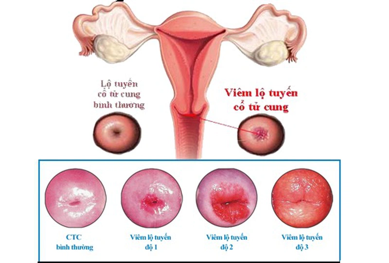 Những thông tin chia sẻ mà bạn cần biết về vấn đề viêm lộ tuyến tử cung nên ăn gì