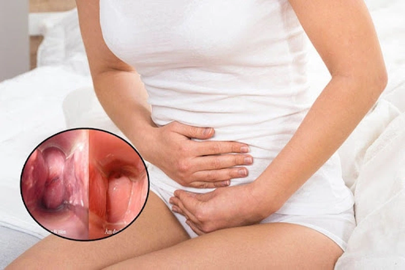 Tại sao viêm lộ tuyến cổ tử cung gây chậm kinh? 1