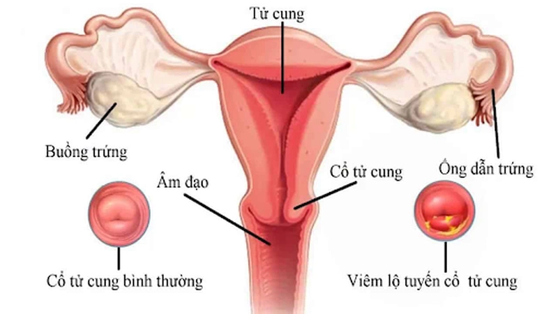 Viêm lộ tuyến cổ tử cung có tự khỏi không? Lưu ý để mau chóng khỏi bệnh 1