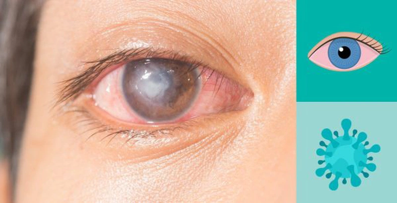 Nguyên nhân và cách khắc phục tình trạng viêm loét giác mạc 1