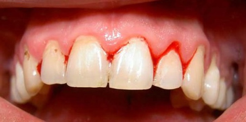 Nguyên nhân và cách điều trị bệnh viêm lợi