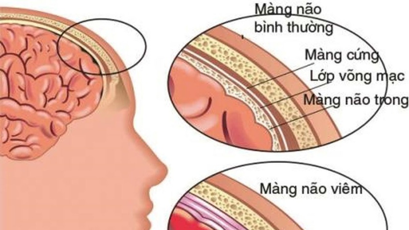 Viêm màng não mủ ở trẻ sơ sinh có nguy hiểm không 1