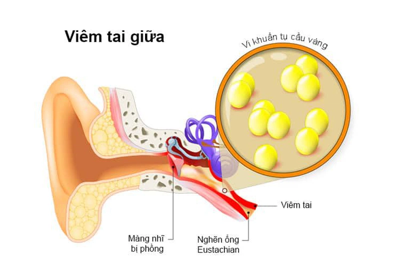 Bệnh viêm mê nhĩ là khi mê nhĩ bị nhiễm trùng do vi khuẩn ở tai trong