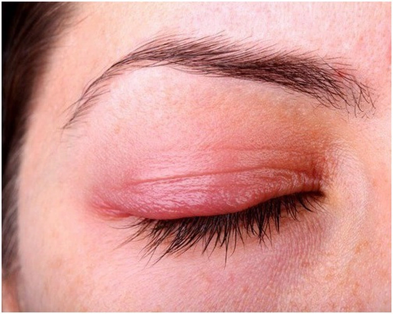 Bệnh viêm mi mắt là gì? Những điều cần biết về viêm mi mắt 1