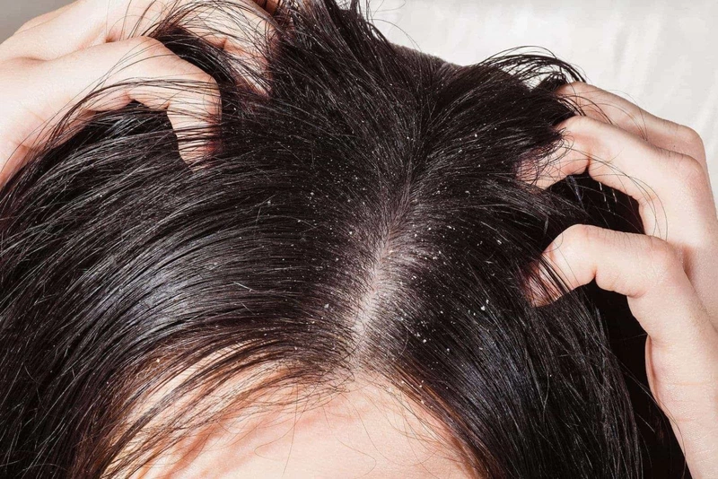 Viêm nang lông da đầu có lây không?2