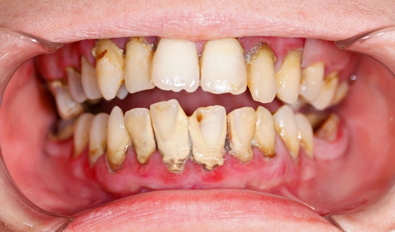 Những thông tin mà bạn cần biết về viêm nha chu cấp  1