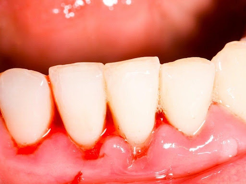 Những chia sẻ về vấn đề viêm nha chu có lây không mà bạn cần nên tham khảo