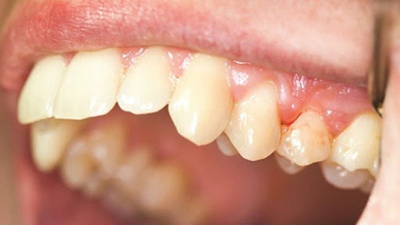 Những chia sẻ về vấn đề viêm nha chu có lây không mà bạn cần nên tham khảo