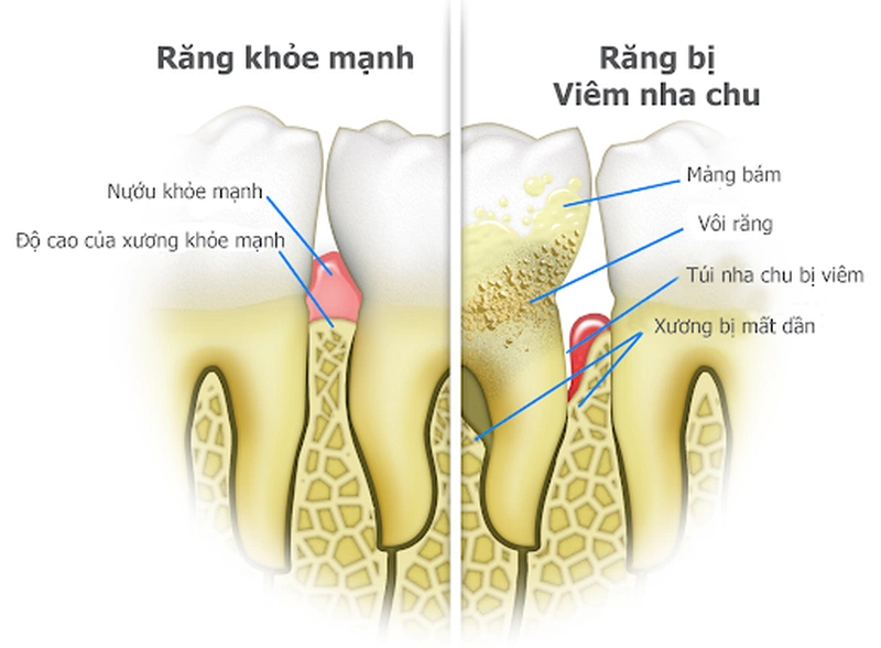 Các cách chữa viêm nha chu có mủ hiệu quả