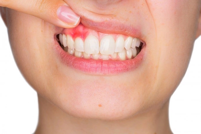 Các cách chữa viêm nha chu có mủ hiệu quả
