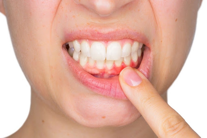 Mời bạn tìm hiểu về vấn đề viêm nha chu có niềng răng được không?