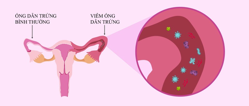 Viêm ống dẫn trứng nếu không được chữa trị kịp thời rất dễ gây vô sinh