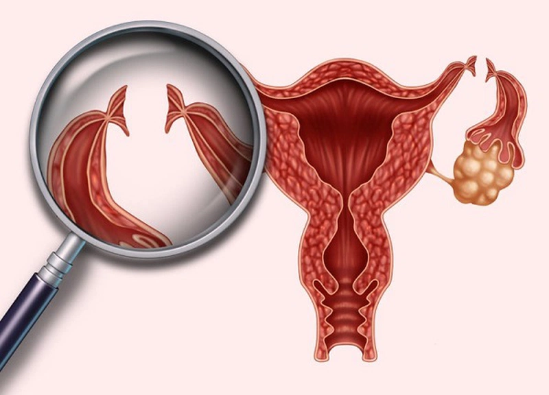 Viêm ống dẫn chứng xảy ra do sự xâm nhập của một số vi khuẩn gây bệnh vào ống dẫn trứng