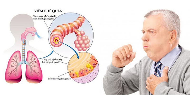 Viêm phế quản co thắt: sự nguy hiểm nếu không chữa trị kịp thời 1