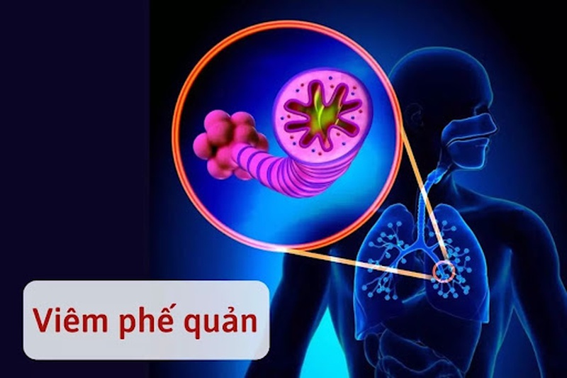 Viêm phế quản co thắt: sự nguy hiểm nếu không chữa trị kịp thời 2