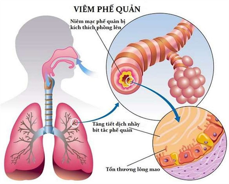 Những thông tin cần thiết về viêm phế quản phổi ở người lớn