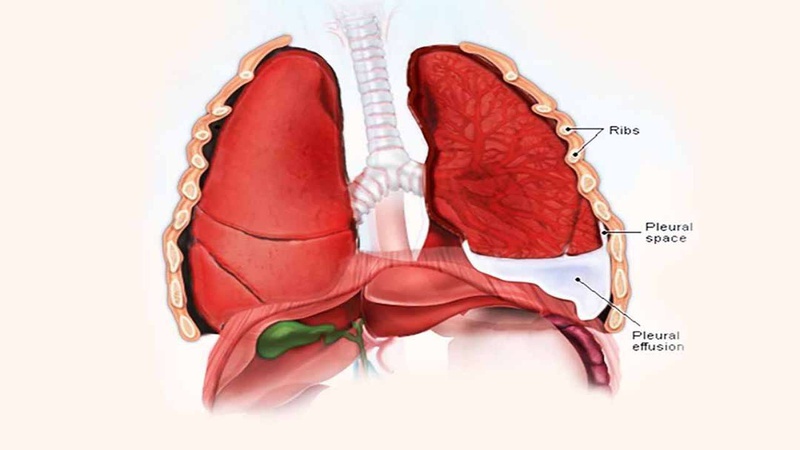 Viêm phổi cấp ở trẻ em không nên chủ quan 1