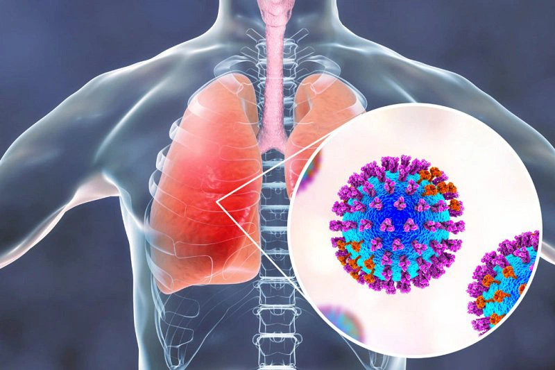 Viêm phổi có lây không? Viêm phổi có di truyền không? Cách phòng ngừa 2