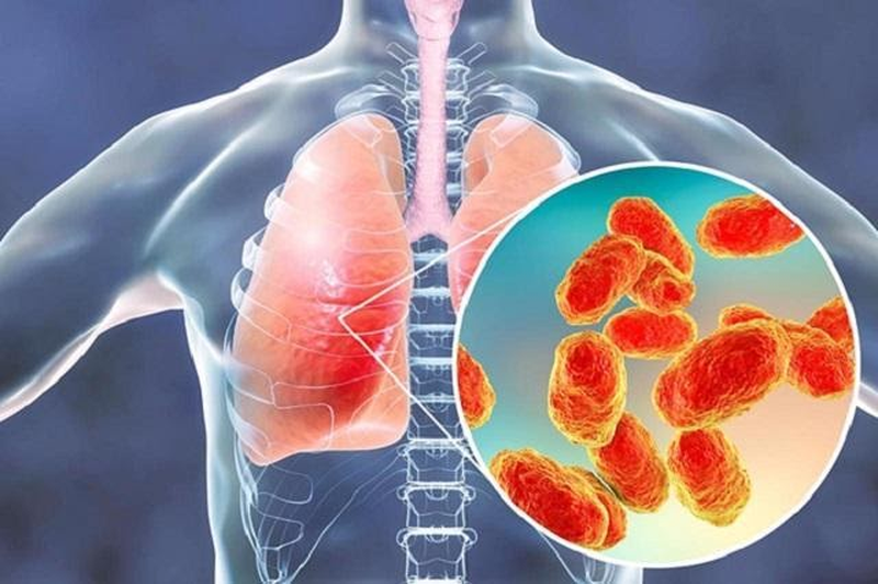 Viêm phổi hoại tử có nguy hiểm không? Nguyên nhân, triệu chứng và cách phòng ngừa bệnh 2
